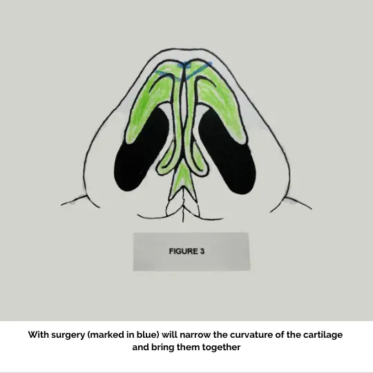 Bifid Nose Figure 3