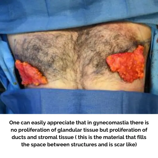 Male Gynecomastia During Surgery