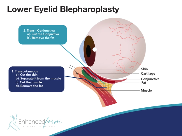 EnhancedForm Eyelid Blepha