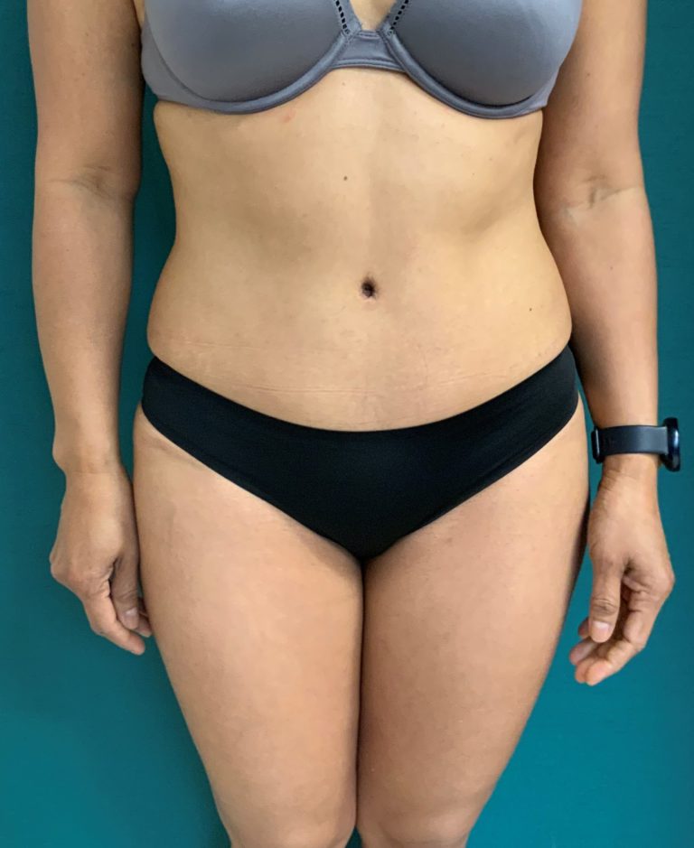 Dr. Makhlouf Tummy Tuck Results