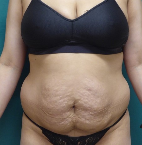 Loose Skin Before Tummy Tuck Surgery
