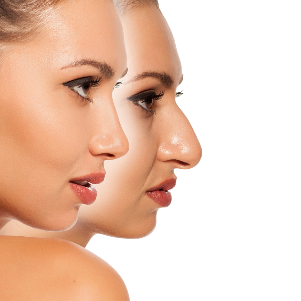 Rhinoplasty Nose Job Surgery In Chicago By Makhlouf