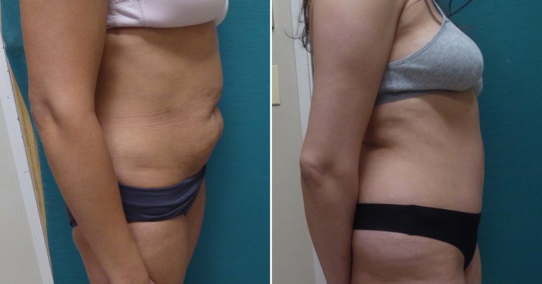 33-year old female tummy tuck side view