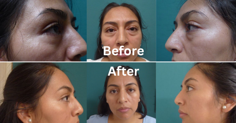 Female Eye Lid Surgery Before And After