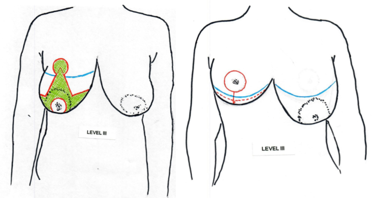 Breast Augmentation Level III