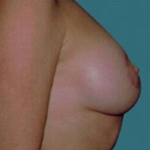 Level 1 Breast Lift Before And After