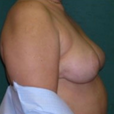 Level 2 Breast Lift Before And After