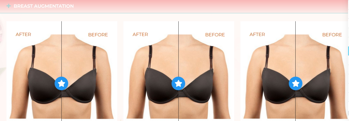 Breast Before and After Gallery