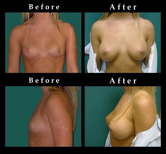 Breast Augmentation – Mammaplasty Photos – #2454
