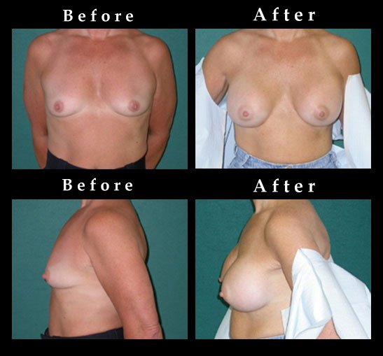 Breast Augmentation – Mammaplasty Photos – Ref. #2453