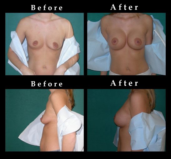 Breast Augmentation – Mammaplasty Photos – #2452