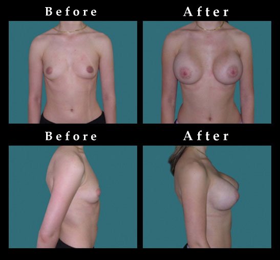 Breast Augmentation – Mammaplasty Photos – #2451