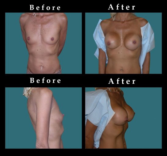 Breast Augmentation – Mammaplasty Photos – #2450