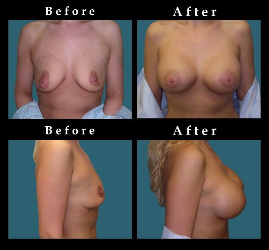 Breast Augmentation – Mammaplasty Photos – #2449