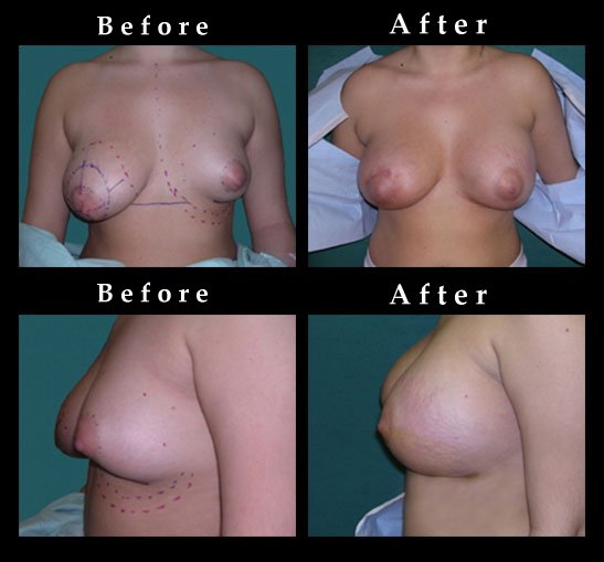 Breast Augmentation – Mammaplasty Photos – #2448