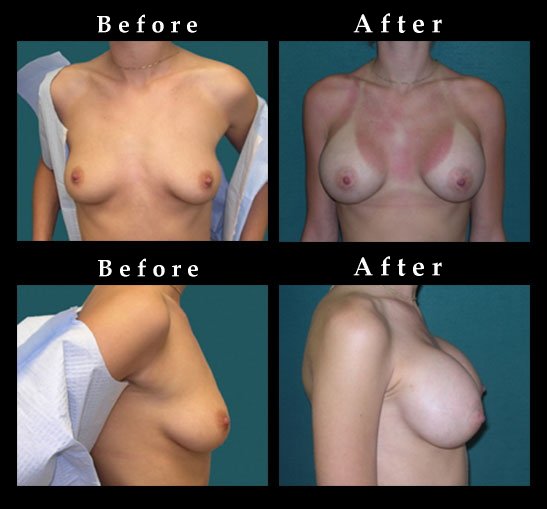 Breast Augmentation – Mammaplasty Photos – #2447