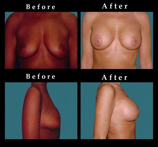 Breast Augmentation – Mammaplasty Photos – Ref. #2446
