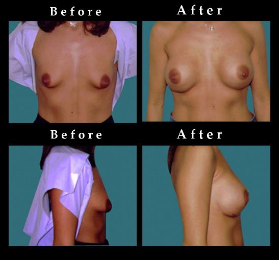 Breast Augmentation – Mammaplasty Photos – #2445