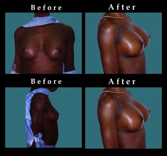 Breast Augmentation – Mammaplasty Photos – #2444