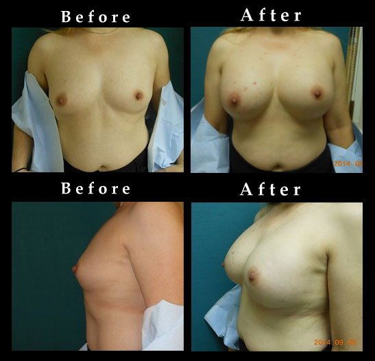 Breast Enhancement and Asymmetry Correction
