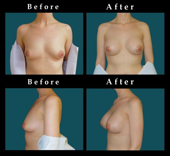 breast-enhancement-augmentation