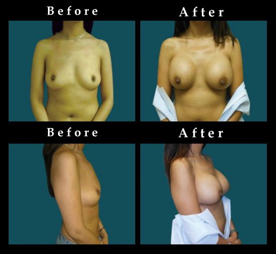 Breast Augmentation – Mammaplasty Photos – #2440