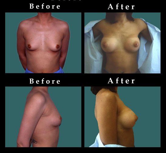 Breast Augmentation – Mammaplasty Photos – #2442
