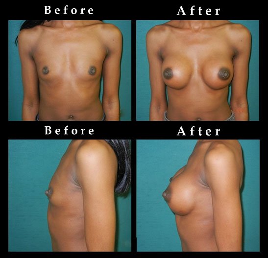 Breast Augmentation – Mammaplasty Photos – Ref. #2541