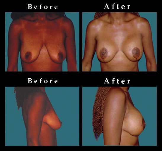Breast Lift – Mastopexy Photos – #2456