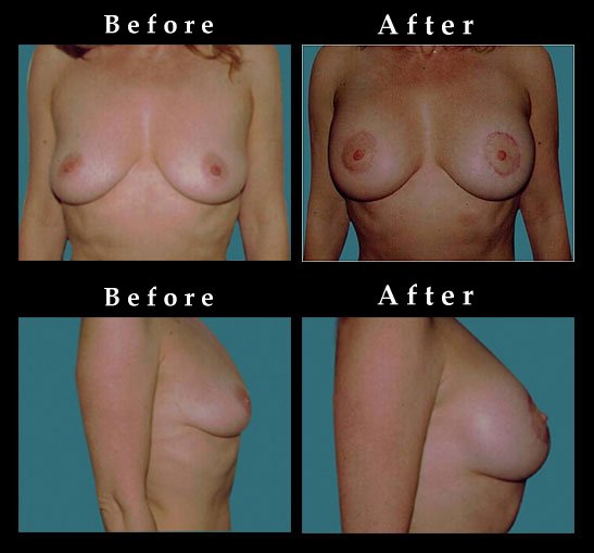 Breast Lift – Mastopexy Photos – #2457