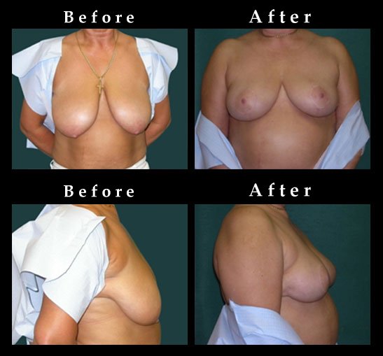Breast Lift – Mastopexy Photos – Ref. #2459