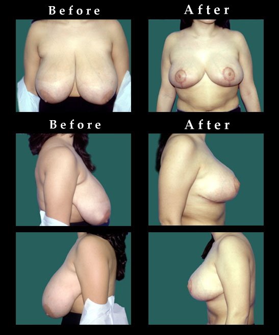 Breast Reduction Photos – Ref. #2471
