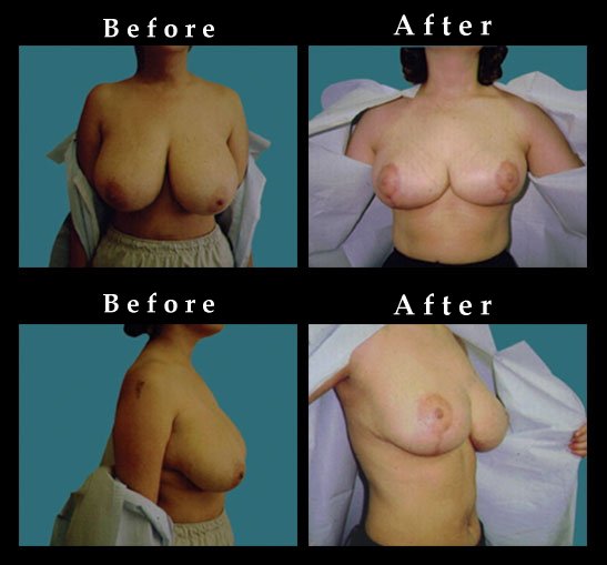 Breast Reduction Photos – Ref. #2472