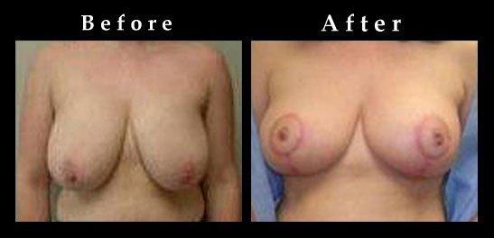 Breast Reduction Photos – Ref. #2473