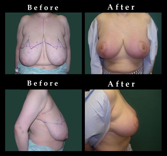 Breast Reduction Photos – Ref. #2474