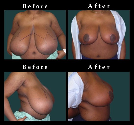 Breast Reduction Photos – Ref. #2475