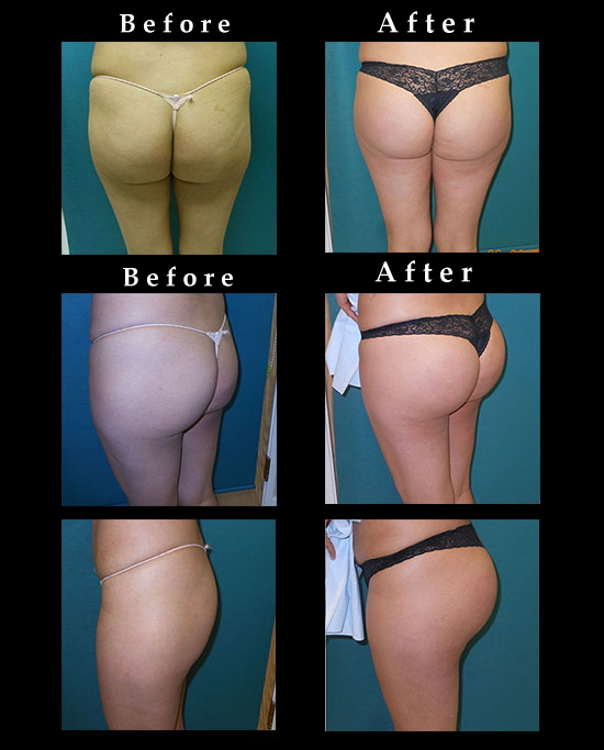 Buttock Augmentation with Implants