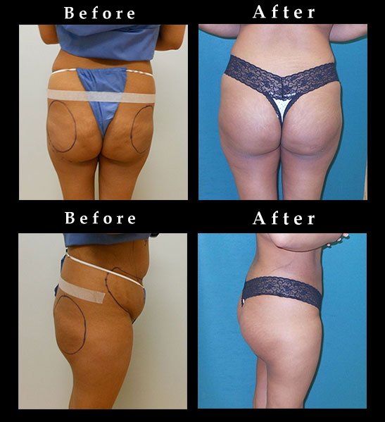 Buttock Augmentation with Implants and liposuction of the abdomen