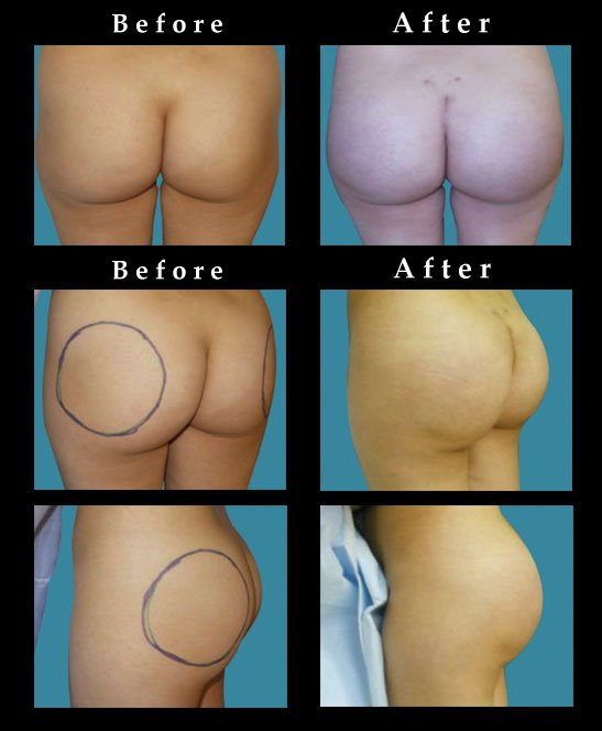 Buttock Augmentation with Silicone Implants