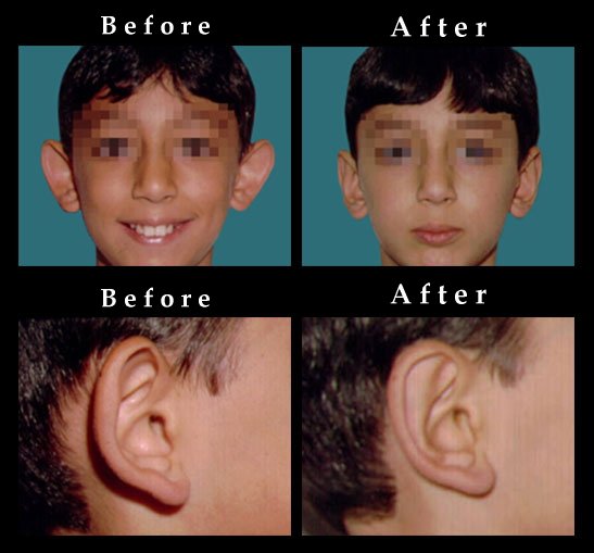 Ear Pinning (Otoplasty) / Before and After Photos Chicago
