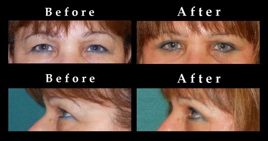 Upper Eyelid Surgery Before and After Pictures