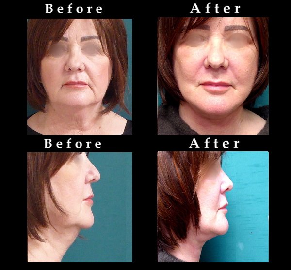 Face Lift, Neck Lift and Eyelid
