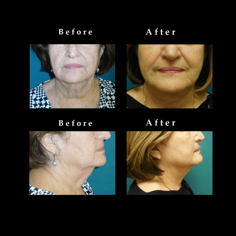 Face Lift – Rhytidectomy Before and After Photos