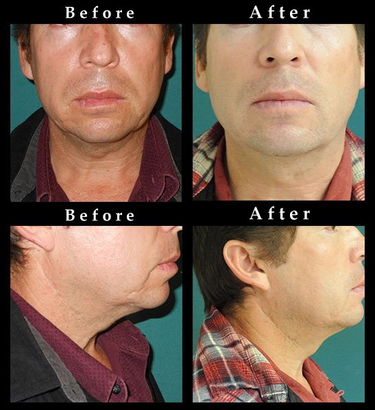 Thermi and Fillers- Facial Rejuvenation