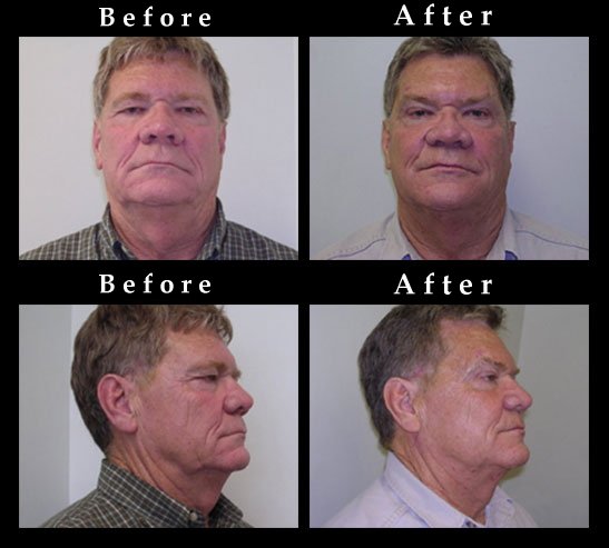 Facial Rejuvenation Photos – Ref. #2527