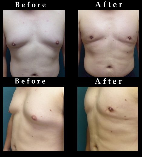 Male Breast Reduction Surgery Before and After Photos