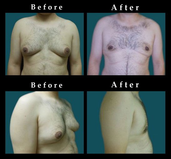 Male Breast Reduction – Gynecomastia Photos – #2476