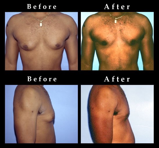 Male Breast Reduction – Gynecomastia Photos – #2478