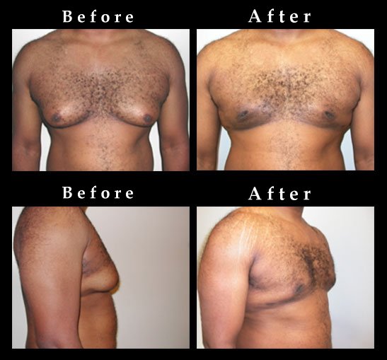 Male Breast Reduction – Gynecomastia Photos – #2479
