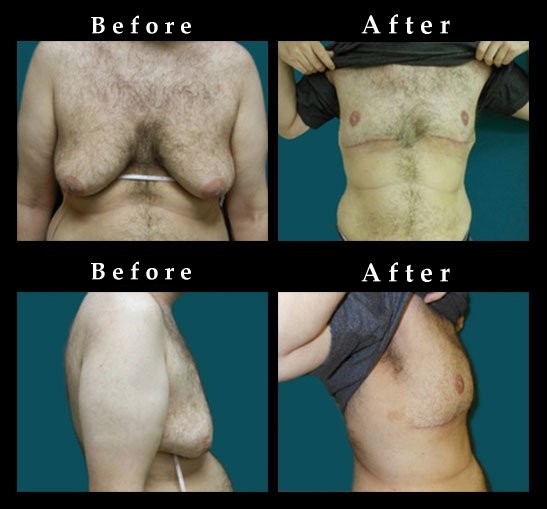 Male Breast Reduction – Gynecomastia Photos – #2481